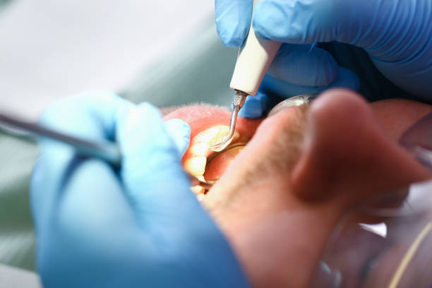 Best Emergency Wisdom Teeth Removal in Randolph, WI